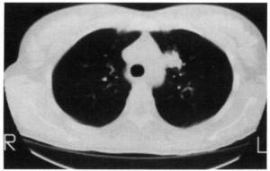 Figure 1. Computerized tomography of chest (case 1) showing pulmonary nodule.