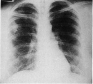 Figure 4. Chest x-ray film (case 2) showing ill-defined stellate density in right upper lobe and increased interstitial markings bilaterally.