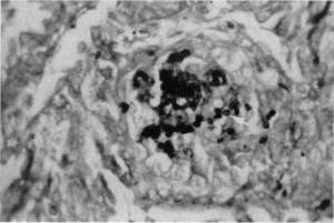 Figure 6. Area identical to that in Figure 5 showing numerous cysts of Pneumocystis carinii within the granuloma (arrow). (Grocott methenamine silver x200.)