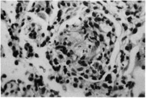 Figure 5. Transbronchial biopsy specimen (case 3) showing a better formed granuloma composed of histiocytic cells and a few lymphocytes. (Hematoxylin-eosin X 200.)
