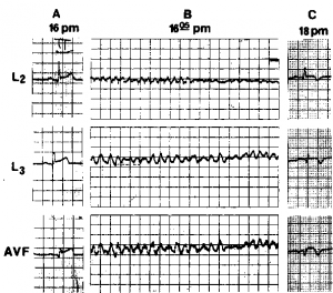 Figure 1. Example of type 1 VF in patient with inferior wall infarction (patient 1; Table 1). A. Electrocardiogram on admission (leads 2, 3, and aVF), demonstrating stage 1 of inferior wall infarction with minimal Q waves (<2 mm). B. Type 1 VF (fine VF). C. Two hours later. Stage 3 of inferior wall infarction is observed.