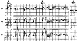 Figure 2. Three-channel ECG showing evolution of anterior wall myocardial infarction complicated by type 2 VF (patient 21; Table 3). A. Electrocardiogram on admission (leads V^ V2, and V3), showing stage 1 of anterior wall infarction. B. Type 2 VF (polymorphous VF) during stage 2 of AMI (Q waves more than 2 mm are seen before onset of VF). C. Two hours later. Stage 3 of anterior wall infarction is observed.