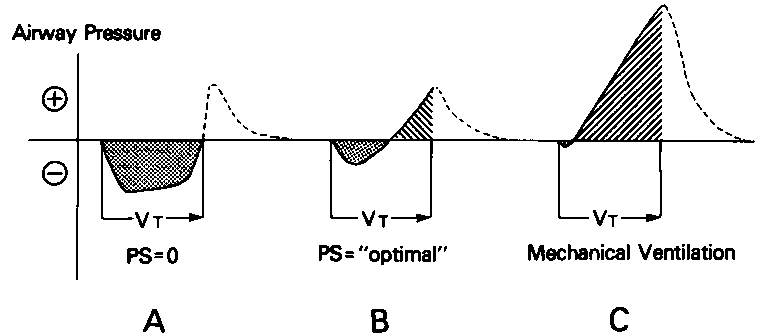 Figure 2. Airway pressure-volume curves with increasing pressure support. Schematic shows airway pressure-volume curves generated by mechanical breathing model with endotracheal tube and ventilator circuit. Shaded areas represent Wrs; and hatched areas represent Wv without pressure support (A) and with “optimal'’ pressure support (that level at which Wrs-Wv and Waw = 0) (B). With higher levels of pressure support (C), Waw is negative (ie, performed mostly by pressure-support system).
