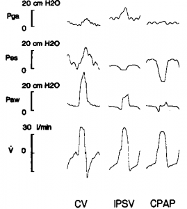 Figure 2. Individual recording (patient 7) of gastric pressure (Pga), esophageal pressure (Pes), airway pressure (Paw), and respiratory flow(V) under controlled ventilation (CV), 15 cm H20 inspiratory pressure support ventilation (IPSV) and continuous positive airway pressure (CPAP). One respiratory cycle is depicted for each ventilatory condition. Note that under IPSV, Pes decreases during inspiration, whereas Pga increases.