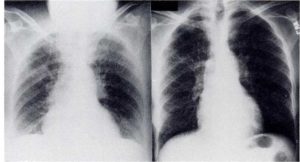 Figure 2. The second patient had a predominantly interstitial infiltrate on admission AP chest roentgenogram (left) that improved on PA roentgenogram at 21 days (right).