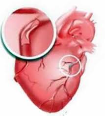 Ischemic heart disease