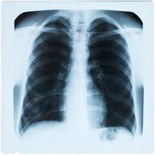 Restricted Pulmonary Function in Cystic Fibrosis: Discussion